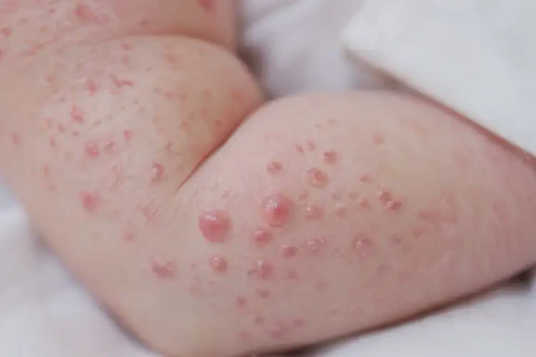 新生兒手臂上經(jīng)常長(zhǎng)濕疹能靠自己自愈嗎(圖4)