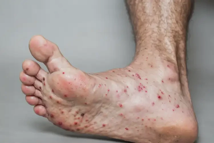 老人腳上偶爾起濕疹不管它會自己痊愈嗎(圖4)