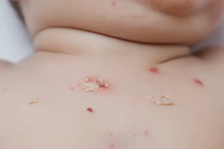 嬰幼兒脖子長濕疹不管它會自己好嗎(圖4)