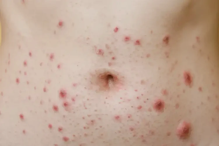 女人肚子上偶爾長(zhǎng)濕疹能夠徹底治愈嗎(圖4)