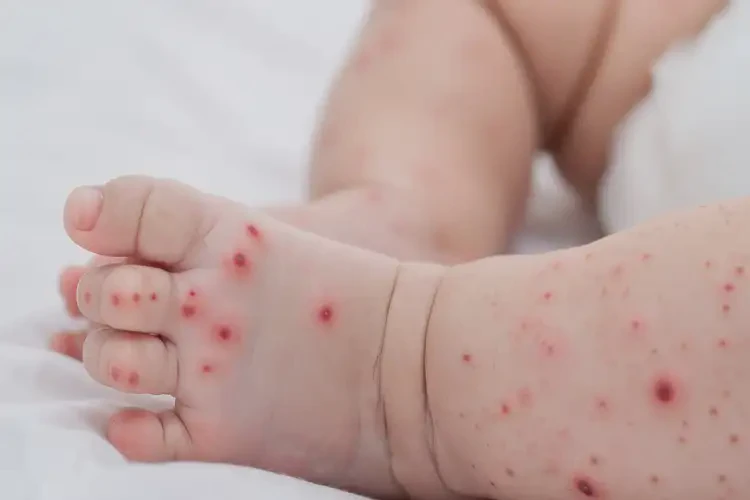 嬰兒四肢有濕疹不管它會自己痊愈嗎(圖4)