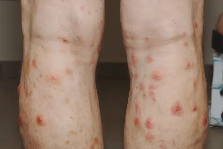 男人四肢偶爾起濕疹能徹底自愈嗎(圖3)