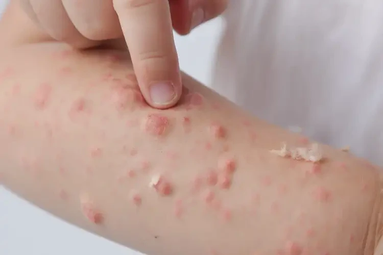 孩子手臂上有濕疹可以徹底自愈嗎(圖3)