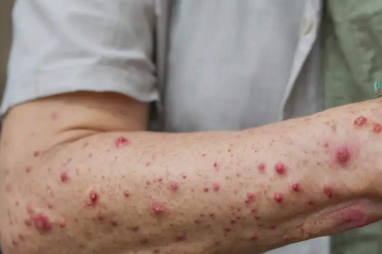 女性身上偶爾起濕疹可不可以徹底自愈(圖4)