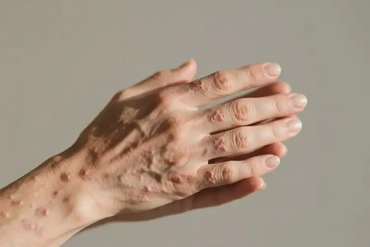 女人手上出現(xiàn)濕疹不管它會(huì)自己好嗎(圖1)