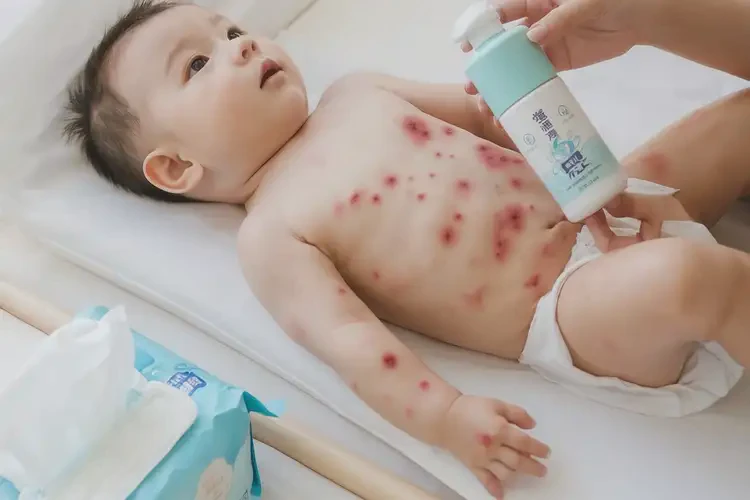 孩子屁股上容易起湿疹可以彻底自愈吗(图4)