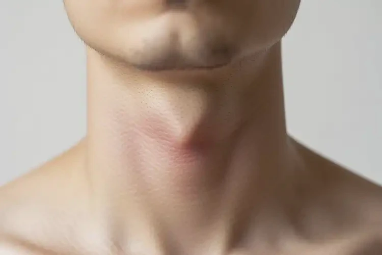 男生脖子上容易長(zhǎng)濕疹能徹底自愈嗎(圖4)