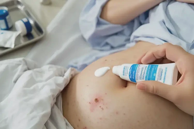 產(chǎn)婦肚子上偶爾長濕疹能靠自己自愈嗎(圖3)