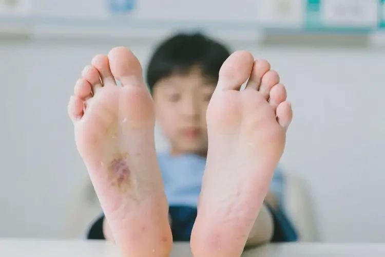 青少年腳上有濕疹可以徹底自愈嗎(圖4)