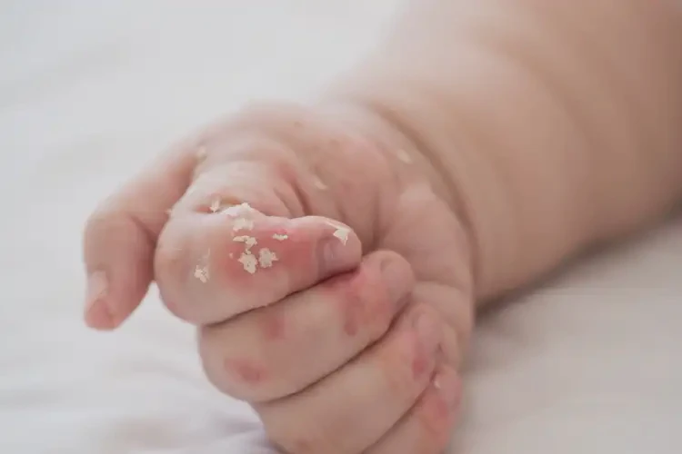 嬰兒手上有濕疹可以徹底自愈嗎(圖4)