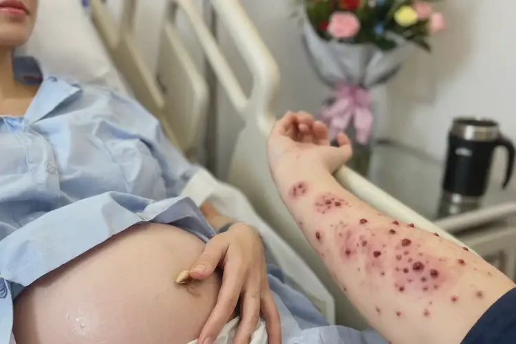 產(chǎn)婦手臂偶爾長濕疹能夠徹底治愈嗎(圖4)