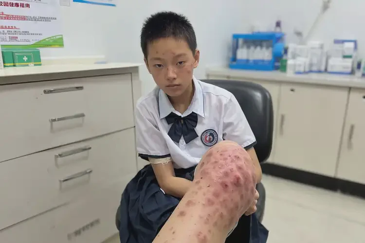 中学生脚上起湿疹能靠自己自愈吗(图4)
