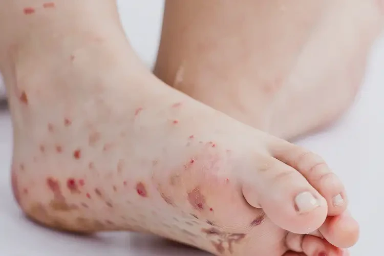 小儿脚上容易长湿疹能彻底自愈吗(图4)