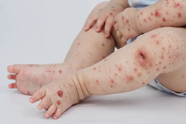 幼兒全身經(jīng)常起濕疹能夠徹底治愈嗎(圖4)