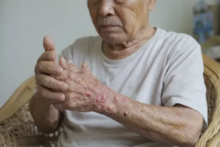 高齡老人屁股上有濕疹不管它會自己好嗎(圖4)