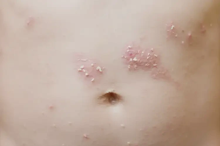 小孩肚子經(jīng)常起濕疹能夠徹底治愈嗎(圖4)