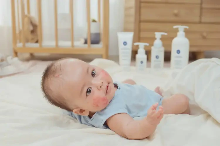 寶寶面部偶爾長(zhǎng)濕疹不管它會(huì)自己好嗎(圖2)