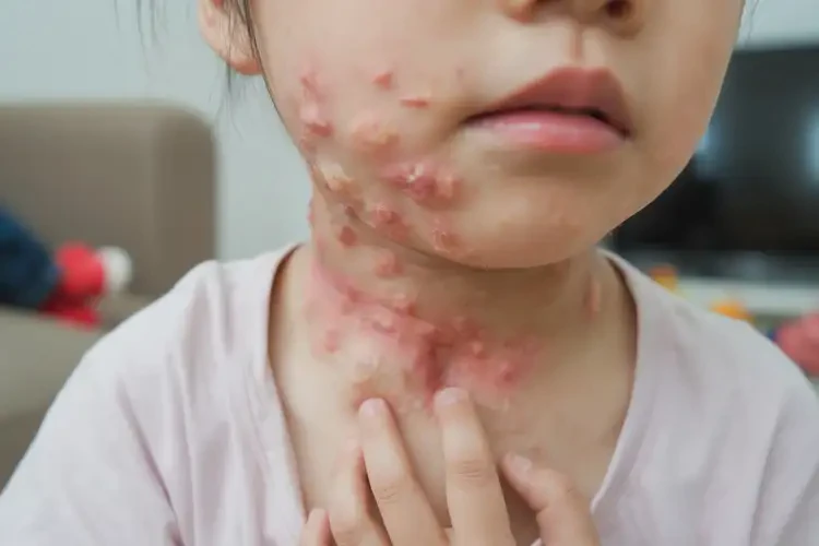 少儿脖子上有湿疹不管它会自己自愈吗(图4)