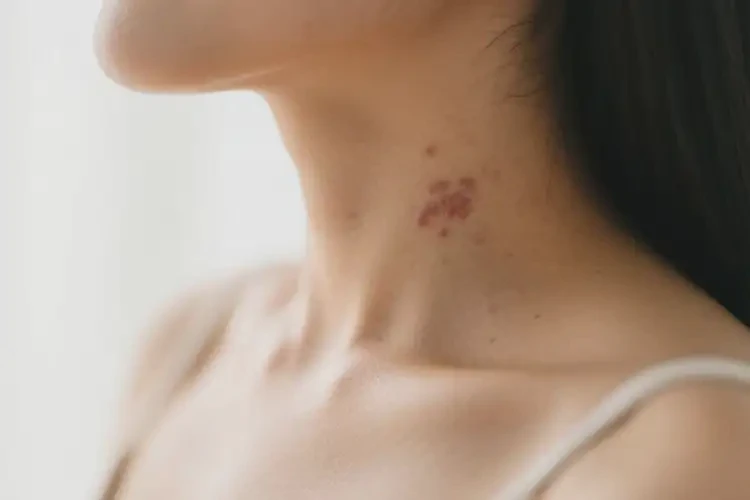 產(chǎn)婦脖子上偶爾起濕疹能靠自己自愈嗎(圖4)