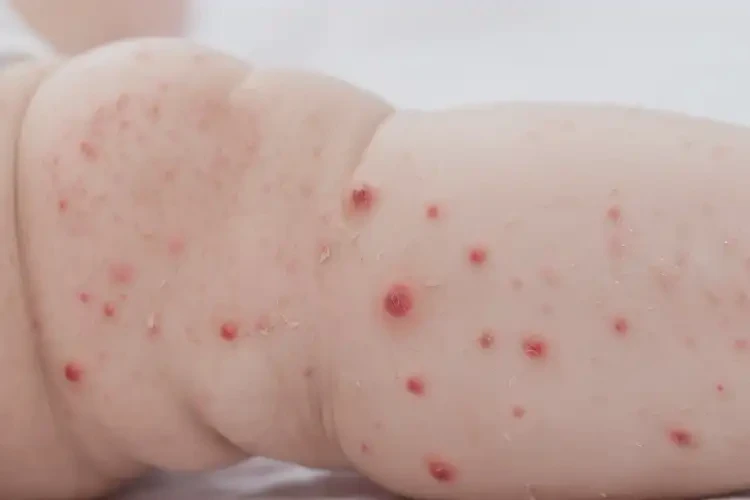 嬰兒小腿經常起濕疹不管它會自己好嗎(圖4)