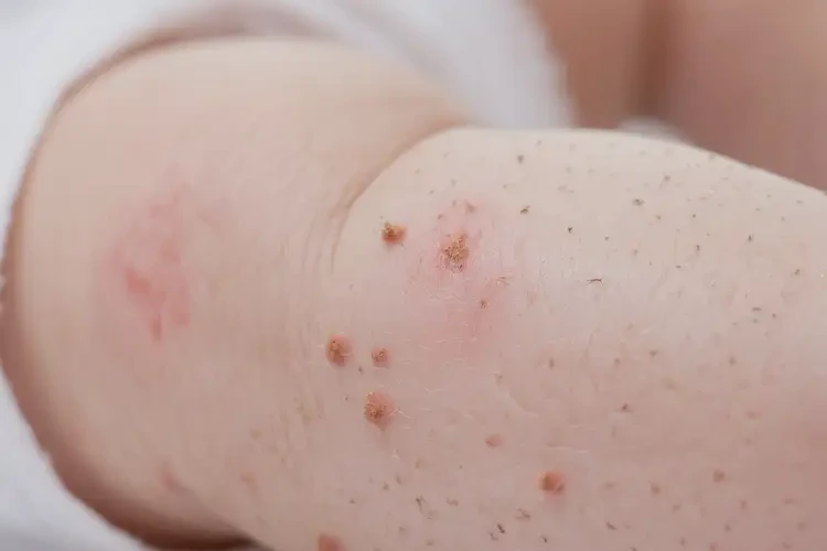 寶寶小腿經(jīng)常起濕疹可不可以徹底自愈(圖4)