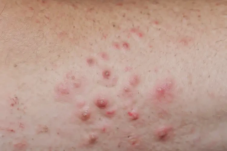 小學(xué)生肚子上經(jīng)常起濕疹不管它會(huì)自己好嗎(圖3)