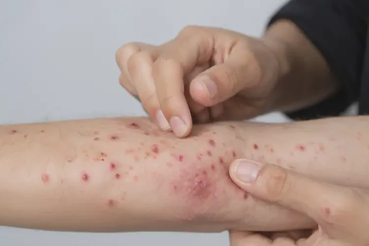 青少年手臂上經(jīng)常起濕疹能不能徹底自愈(圖4)