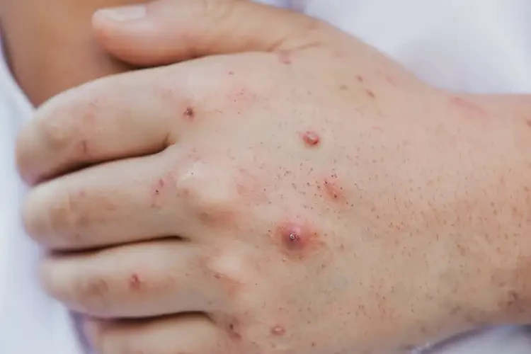 大學(xué)生手上偶爾長濕疹能不能徹底自愈(圖4)