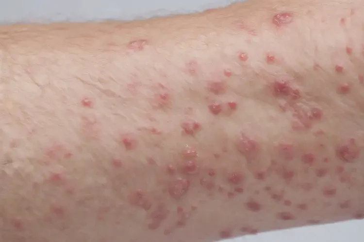 男人屁股上偶爾長(zhǎng)濕疹不管它會(huì)自己自愈嗎(圖3)