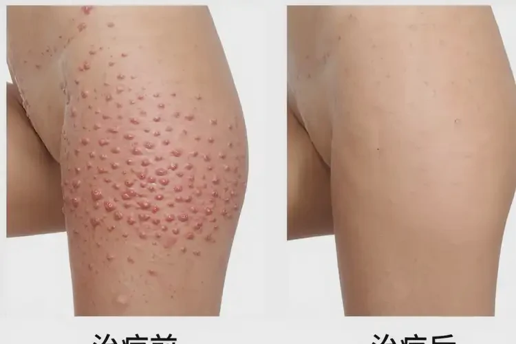 哺乳期媽媽屁股容易長(zhǎng)濕疹能夠徹底治愈嗎(圖3)