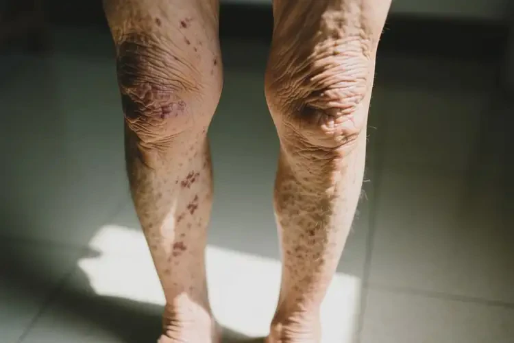 老人大腿出濕疹可不可以徹底自愈(圖2)