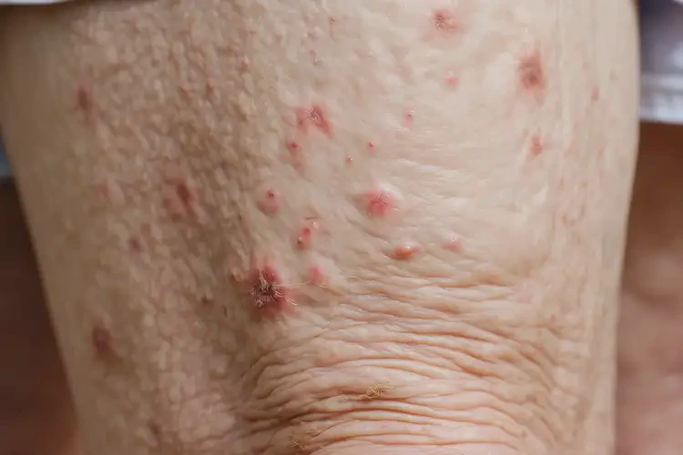 高齡老人大腿上偶爾起濕疹可以徹底自愈嗎(圖4)