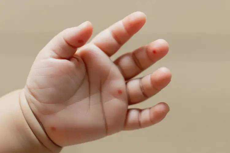 嬰兒手上長濕疹不管它會自己自愈嗎(圖4)