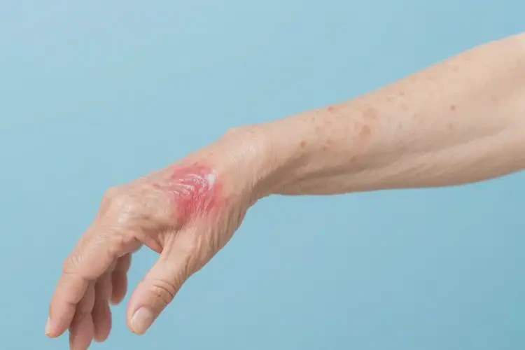 老年人手臂偶爾長(zhǎng)濕疹可不可以徹底自愈(圖2)