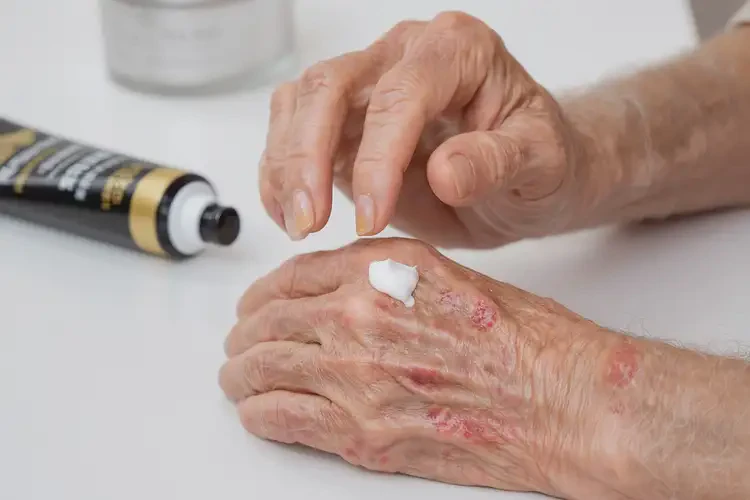 高齡老人手上經(jīng)常起濕疹不管它會(huì)自己痊愈嗎(圖3)