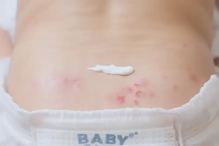 嬰兒肛周偶爾起濕疹可以徹底自愈嗎(圖4)