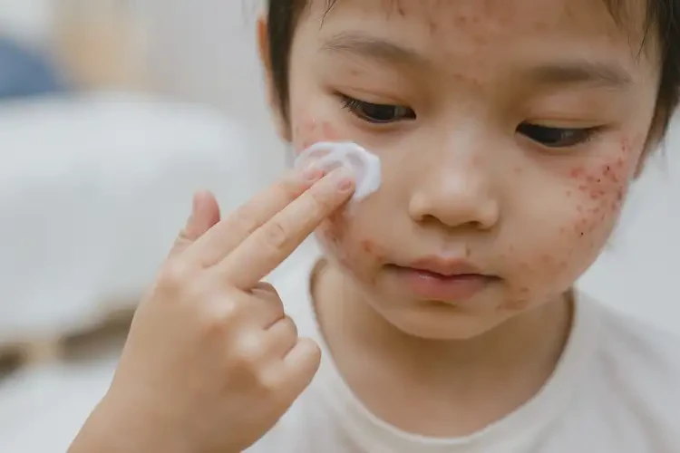 兒童臉上經(jīng)常長濕疹不管它會自己好嗎(圖4)
