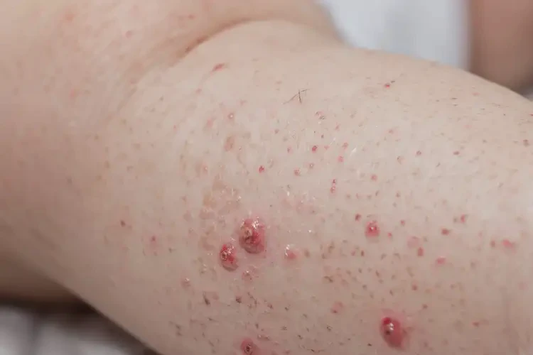 嬰幼兒小腿經常起濕疹能靠自己自愈嗎(圖4)