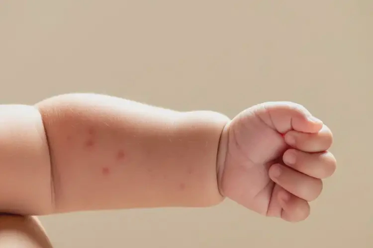 嬰兒手臂上起濕疹不管它會自己痊愈嗎(圖2)