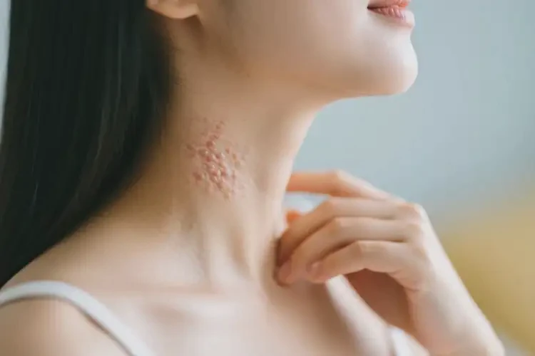 產(chǎn)婦脖子偶爾長濕疹不管它會(huì)自己自愈嗎(圖2)