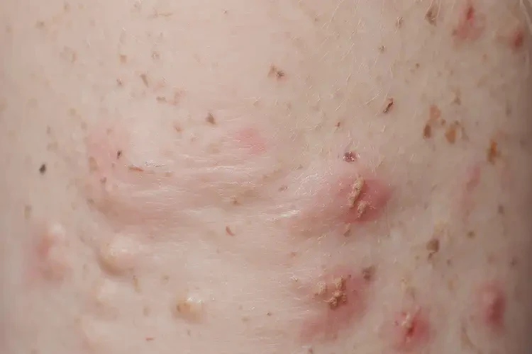 少兒小腿上經(jīng)常起濕疹能徹底自愈嗎(圖4)