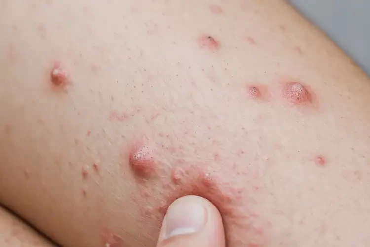 男生大腿出濕疹能徹底自愈嗎(圖4)