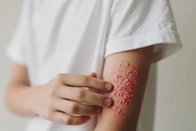 青少年四肢长湿疹不管它会自己痊愈吗(图3)