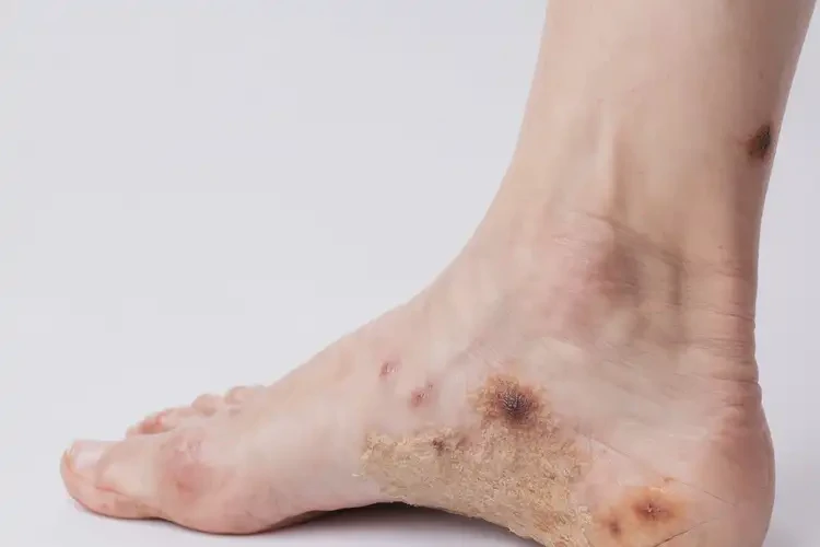 女生腳上偶爾起濕疹不管它會自己自愈嗎(圖1)