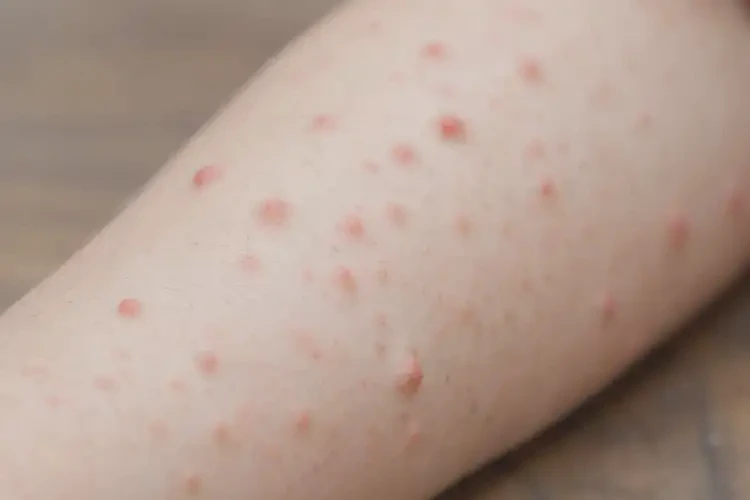 孩子手臂起濕疹不管它會(huì)自己自愈嗎(圖4)