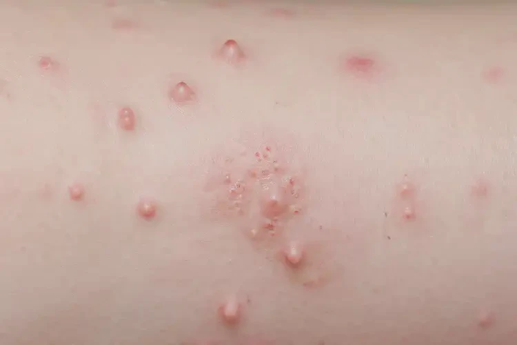 嬰兒脖子經(jīng)常長(zhǎng)濕疹能夠徹底治愈嗎(圖4)