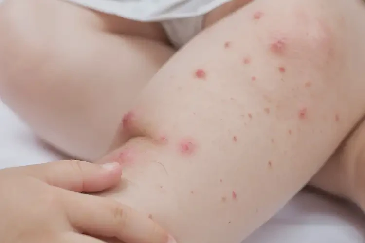 孩子腳上偶爾起濕疹能靠自己自愈嗎(圖4)