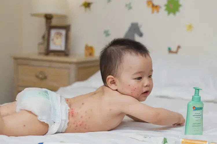 少儿屁股上偶尔起湿疹不管它会自己自愈吗(图4)