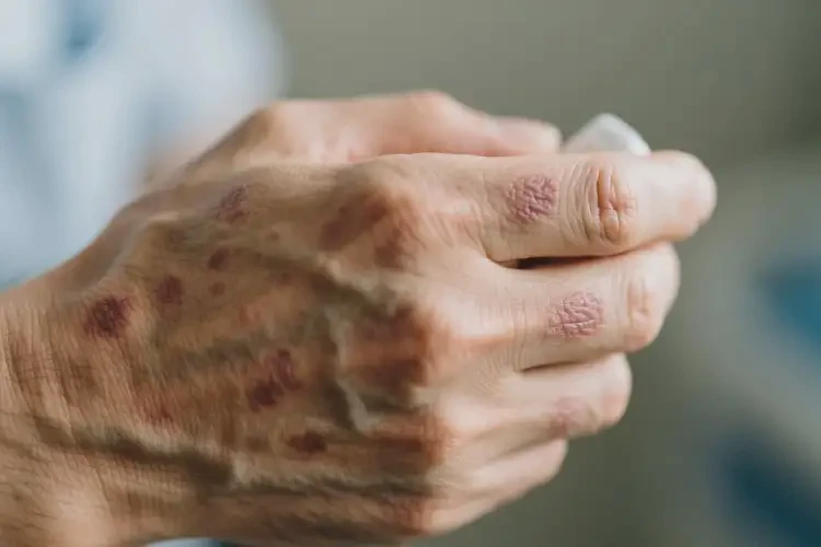 男人手上偶爾起濕疹能徹底自愈嗎(圖2)