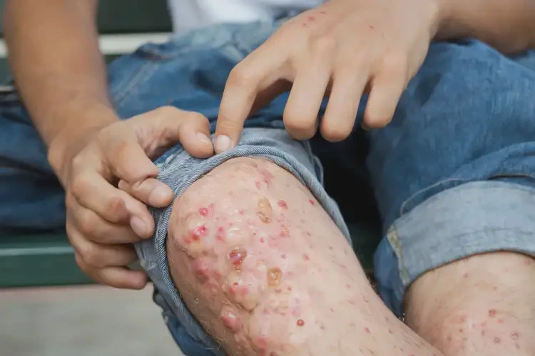 大學生小腿有濕疹不管它會自己好嗎(圖3)